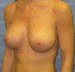 Silicone Breast Augmentation Before & After Image