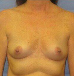 Silicone Breast Augmentation Before & After Image