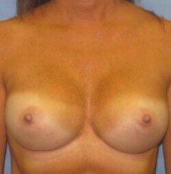 Silicone Breast Augmentation Before & After Image