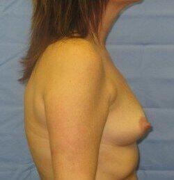 Silicone Breast Augmentation Before & After Image