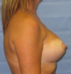 Silicone Breast Augmentation Before & After Image