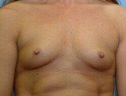 Silicone Breast Augmentation Before & After Image