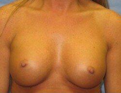 Silicone Breast Augmentation Before & After Image