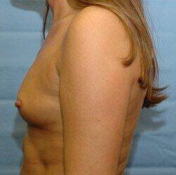 Silicone Breast Augmentation Before & After Image