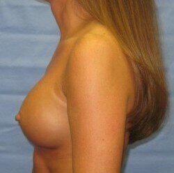 Silicone Breast Augmentation Before & After Image