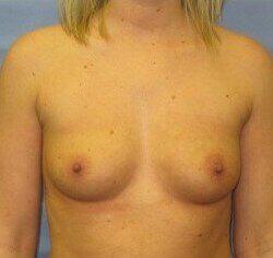 Silicone Breast Augmentation Before & After Image