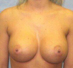 Silicone Breast Augmentation Before & After Image