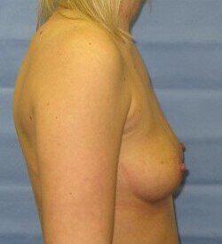 Silicone Breast Augmentation Before & After Image