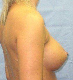 Silicone Breast Augmentation Before & After Image